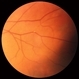 Hollenhorst Plaque in Eye with CRAO Hollenhorst Plaque in Eye with CRAO